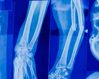 рентген перелом.jpg