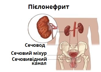 пієлонефрит.jpg