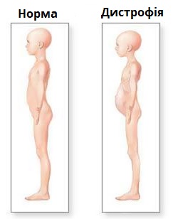 дистрофія.jpg
