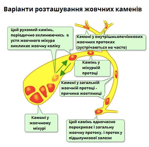 камені жовчного.png