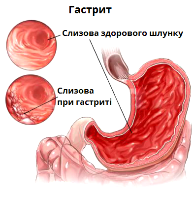 гастрит.png