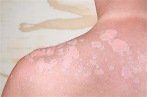 сонячні опіки.png