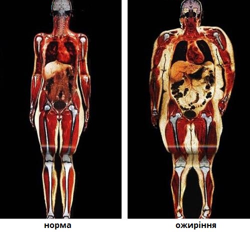 ожиріння.jpg