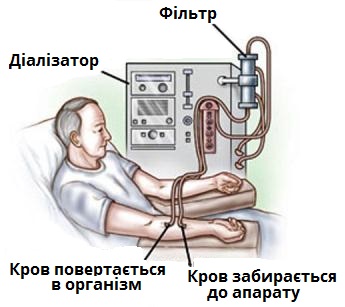 гемодіаліз.jpg