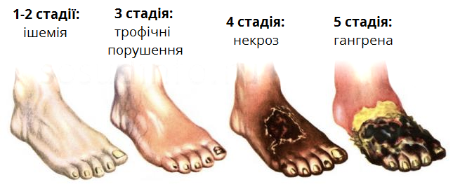 некроз.png